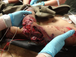 JKSA, COTS Ortho Trauma 10