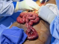 Expeditionary General Surgery - Intestines