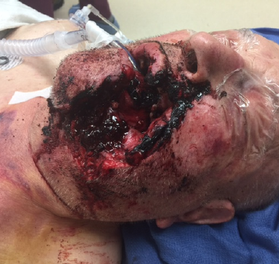 JKSA Trauma 4 - facial surgery
