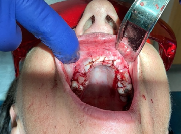 JKSA Trauma 9 - mouth surgery