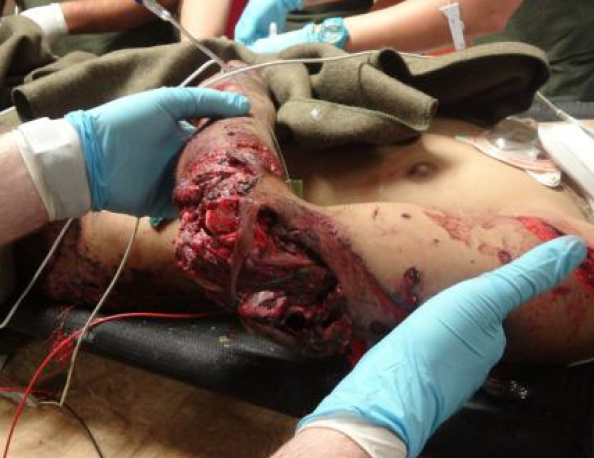 JKSA, COTS Ortho Trauma 10